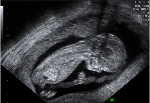 Schwarz-Weiß-Ultraschallbild, das eine Seitenansicht eines sich entwickelnden Fötus im Mutterleib zeigt, wobei der Kopf, der Körper und die Gliedmaßen sichtbar sind. In der oberen rechten Ecke sind Textdaten mit Informationen zur Schwangerschaft und zum Scan zu sehen.