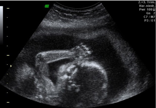 Ultraschallbild, das eine Seitenansicht eines Fötus im Mutterleib zeigt, wobei Kopf, Arm und Hand deutlich zu erkennen sind. Der Fötus scheint seine Hand in der Nähe seines Gesichts zu halten.